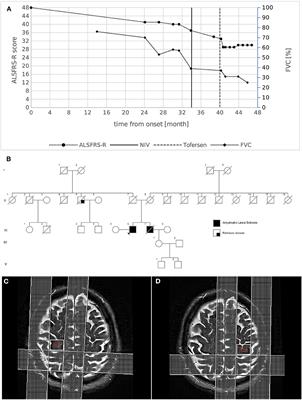 Case report: p.Glu134del SOD1 mutation in two apparently unrelated ALS patients with mirrored phenotype